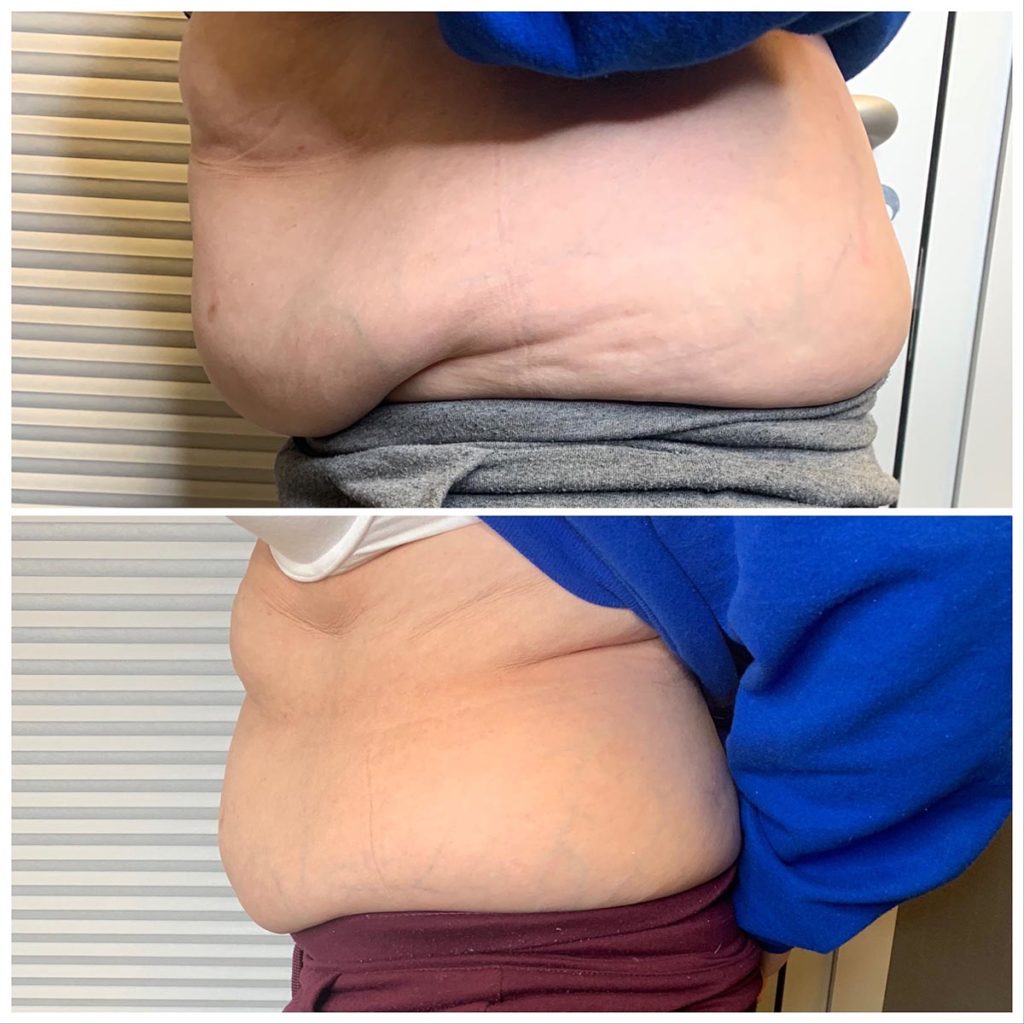 Amanda owner of platinum style and asthetic in colorado next to Cryoskin machine